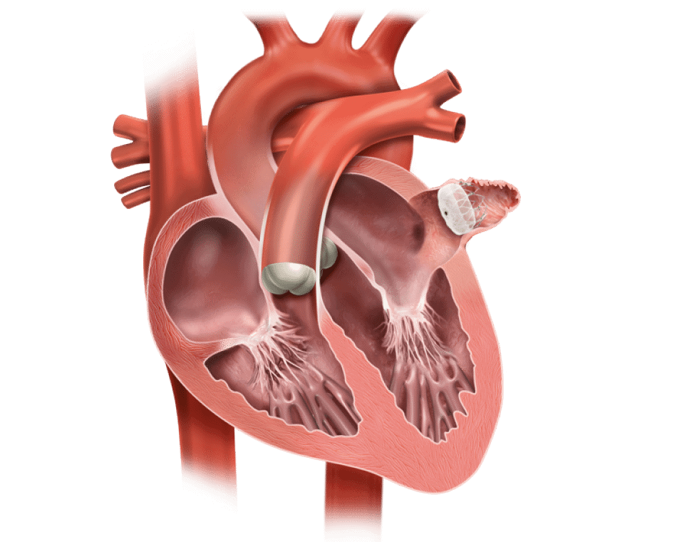 What You Need To Know About WATCHMAN Implants Mowery Clinic